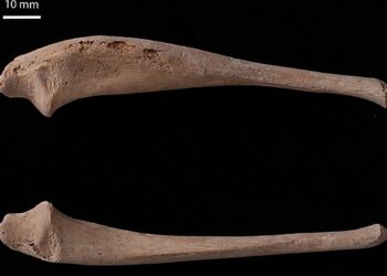 Rare disease possibly identified in skeletal remains of 12th-century child