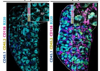 Downregulation of CD21 triggers harmful B cells in lupus
