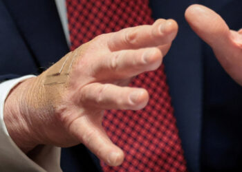 Trump blames his bruises on his daily dose of aspirin