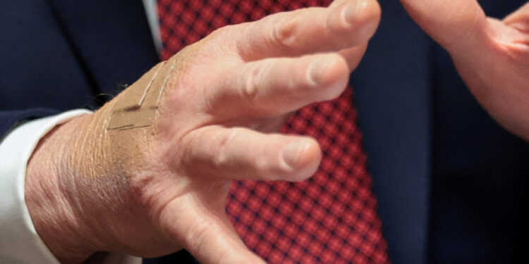 Trump blames his bruises on his daily dose of aspirin